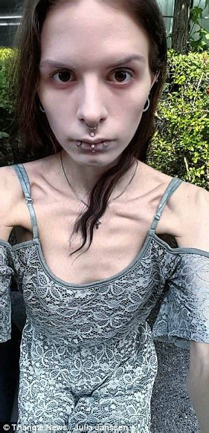 Recovering Anorexic From Zurich Hid Food In Her Ears Daily Mail Online