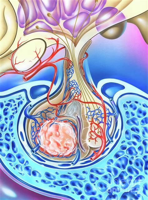 Pituitary Gland Tumour Photograph By John Bavosi Science Photo Library