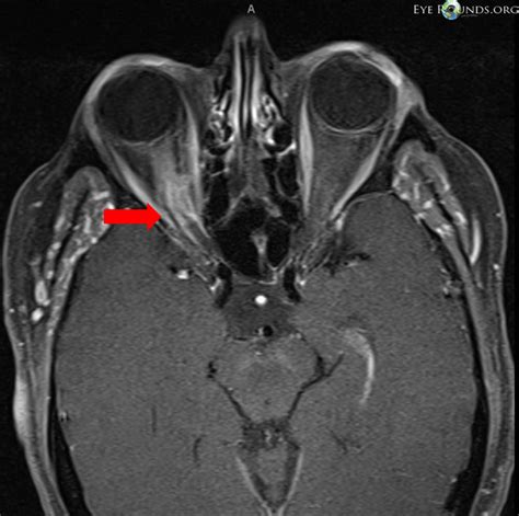 Optic Nerve Sheath Meningioma