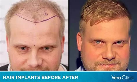 Hair Implants Before After The Best Hair Implants In The World