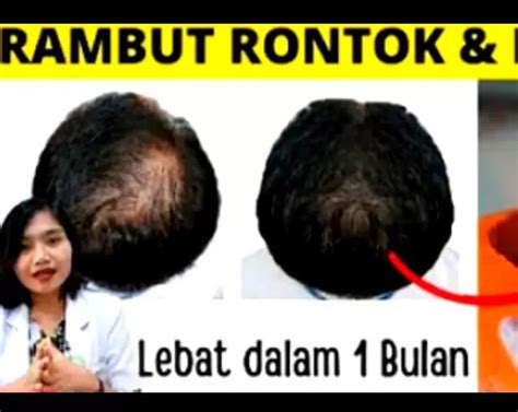 Solusi Untuk Rambut Rontok Dan Botak Ini Dia 3 Jenis Makanan Penumbuh