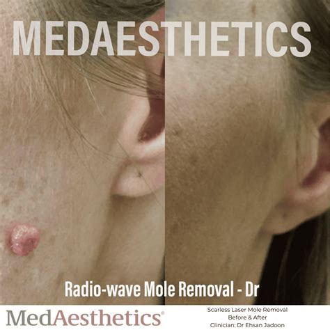 Skin Tag Removal Perth Laser Mole Removal Perth Medaesthetics