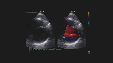 Echokardiografia Przypadek Polpharma Dla Ciebie