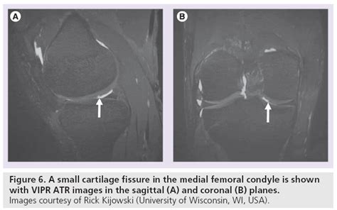Advanced MRI of articular cartilage