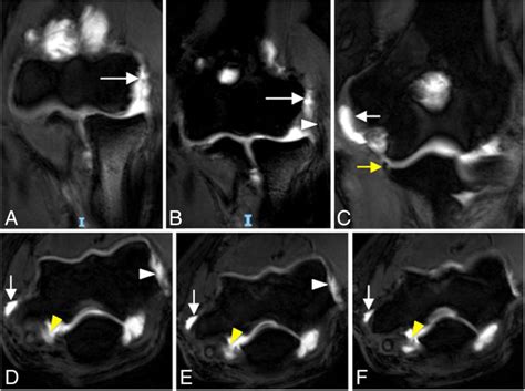 The Elbow Review Of Anatomy And Common Collateral Ligament Complex