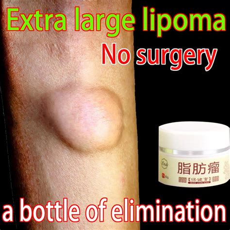 Jual Obat Oles Penghilang Benjolan Lipoma Krim Lipoma Obat Benjolan