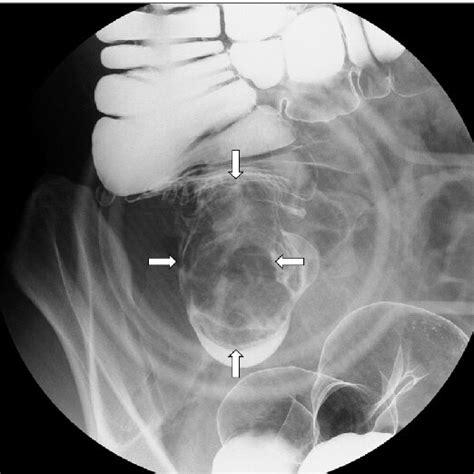 Barium Enema Examination Depicted The Tumor As A Filling Defect