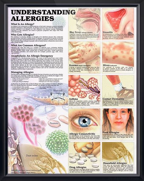Understanding Allergies Chart 20x26 | Most common allergies, Allergies