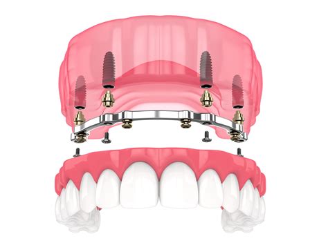 upper denture implants   traditional dentures