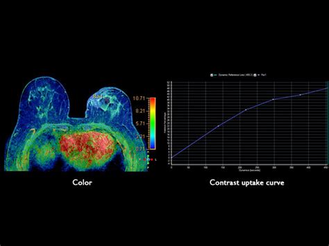 Ds Breast Adaptive 16ch Coil Philips Mr Body Map