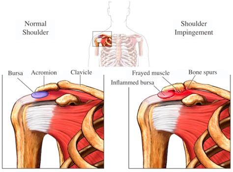 Impingement Syndrome