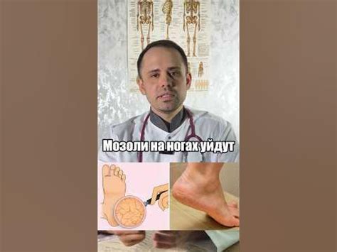 Избавься от мозолей на ногах #здоровье #медицина #доктордешевин # ...