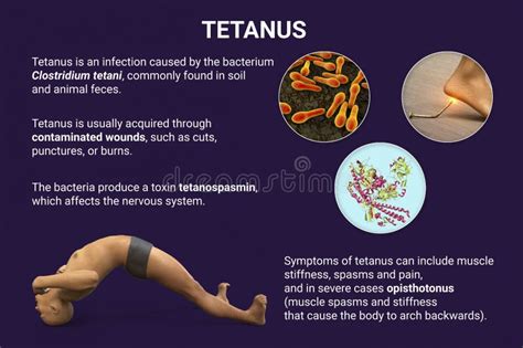 Mechanism Of Tetanus Disease D Illustration Stock Illustration