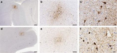 Chronic Traumatic Encephalopathy In A Female Ex Professional Australian