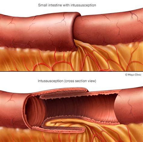 Intussusception Poop