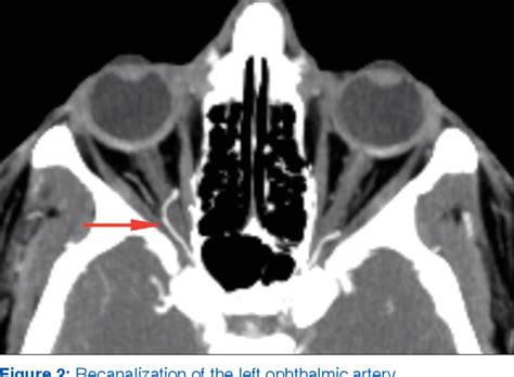 Figure 2 From Acute Monocular Vision Loss As Presenting Symptom Of