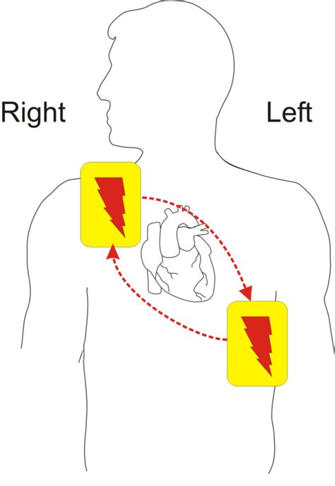 Defibrillator/AED Training | Euro Medical & First Aid Ltd