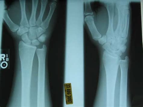 Trapezoid Bone Fracture