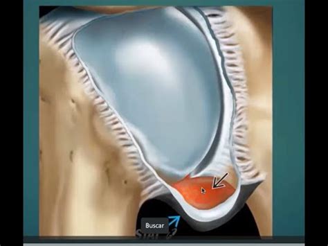 Casos clínicos de AMPEME Capsulitis adhesiva del hombro síndrome de