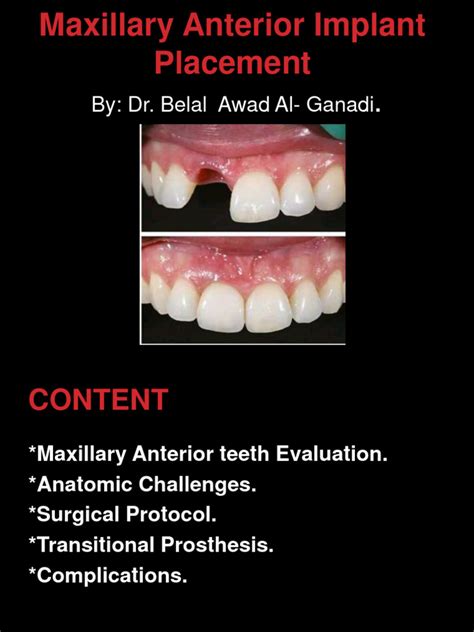 Maxillary Anterior Implant Placement Pdf Dental Implant Medical