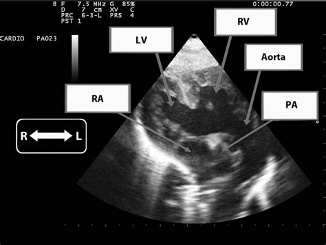 Transthoracic echocardiography subcostal long-axis views. Two ...