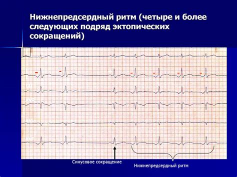 ЭКГ. Интерпретация ЭКГ. Цена деления на ЭКГ - online presentation