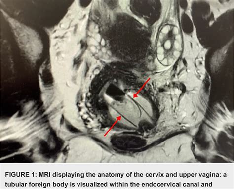 Figure From Retention Of A Foreign Body In The Vagina Of An Adult For Years A Case Report