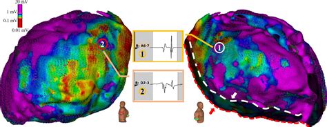 Epicardial Ventricular Tachycardia Ablation Guided By A Novel High