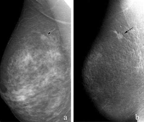 Mammography From Past To Present