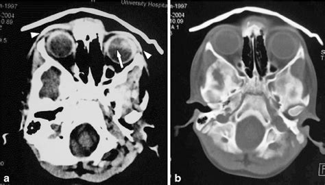 Type I Artefacts On Ct Brain Images A Axial Scan Through The Orbits On