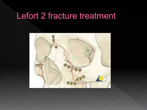 Lefort Fractures Ppt