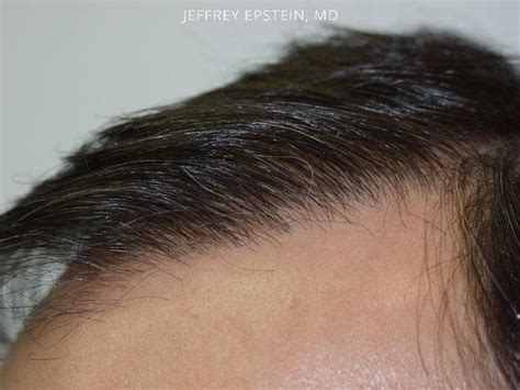 Close Up Hair Transplant Photos Hair Restoration Miami