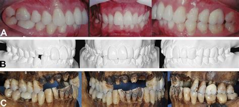 Photographs Ante Mortem A Clinical B Plast Model And Post Mortem