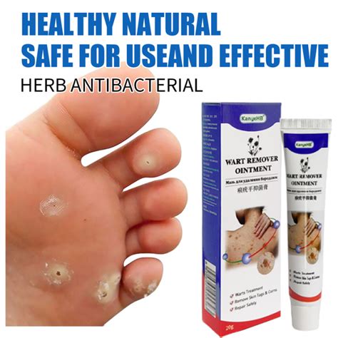 Wart Cream Wart Removal Ointment Warts Skin Tags Remover Mole Removal ...