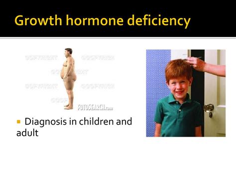 Ppt Anterior Pituitary Insufficiency Powerpoint Presentation Free Download Id 1933409