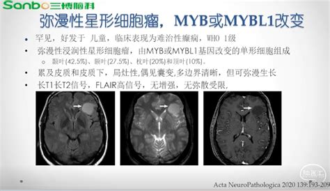 【学术报告整理】儿童型不同级别胶质瘤核磁影像特征——首都医科大学三博脑科医院朱明旺教授分享 脑医汇 神外资讯 神介资讯