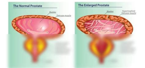 Solution Benign Prostatic Hypertrophy Diagram Studypool