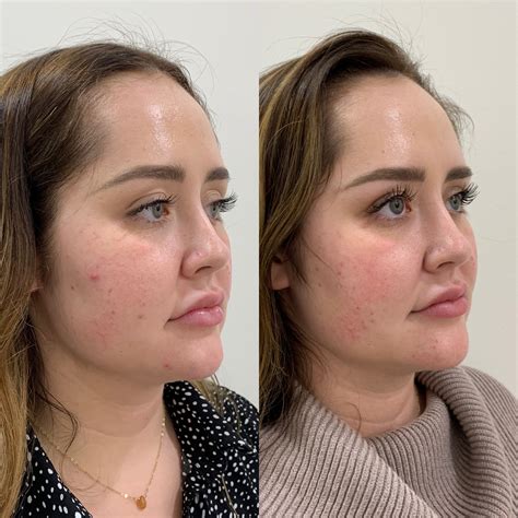 Kybella Before After Images Medspa In Newport Beach Ca