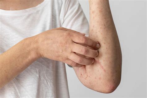 Diferencias Entre Dermatitis Seborreica Y Psoriasis