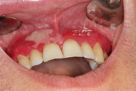 Bullous Pemphigoid In Oral Cavity