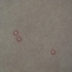Bumps on the thighs | MDedge