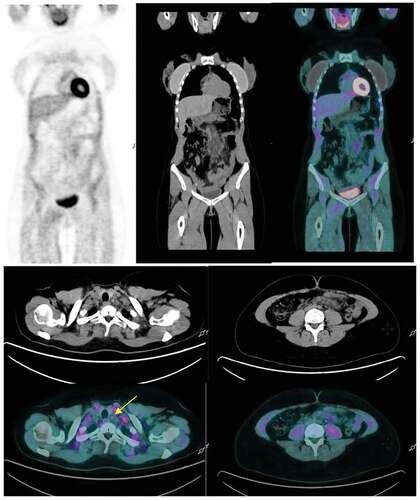 Full Article Hypermetabolic Abdominal And Cervical Lymph Nodes