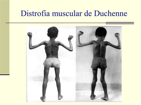 O Que é Distrofia Muscular De Duchenne Tratamento Tem Cura