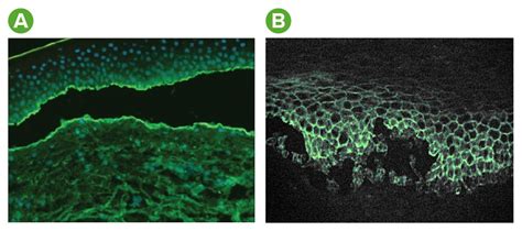 Bullous Pemphigoid And Pemphigus Vulgaris Concise Medical Knowledge