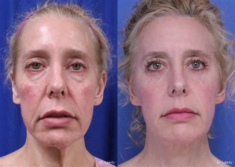 neck lift   gallery