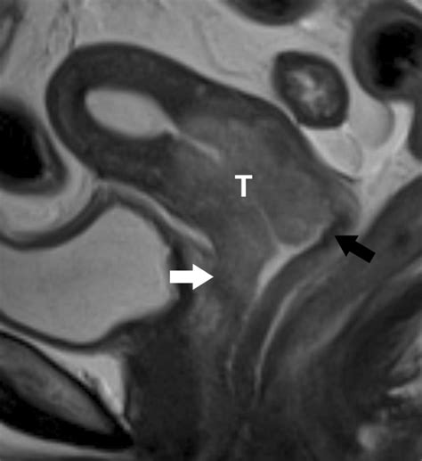 Cervical cancer Stage IIA2. Sagittal T2-weighted image showing a... | Download Scientific Diagram