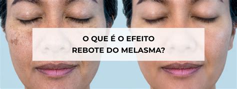 MELASMA CONFIRA O ANTES E DEPOIS DO TRATAMENTO