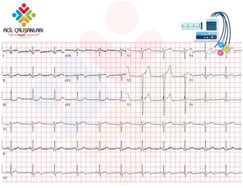 Anterior Miyokard Nfarkt S Acil Al Anlar