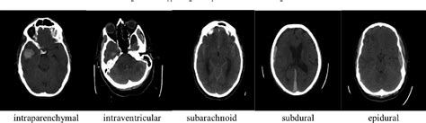 Figure From Feasible Study On Intracranial Hemorrhage Detection And