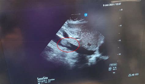 pocus showing larger particles   ivc  scientific diagram